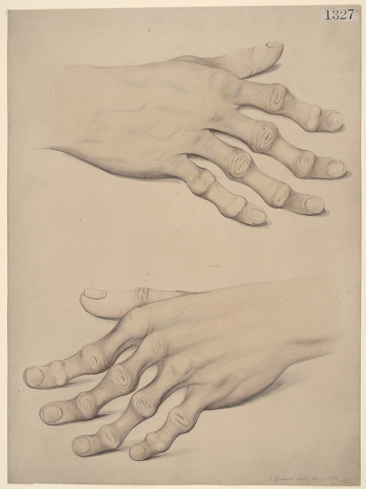 Rheumatoid Arthritis (RA)