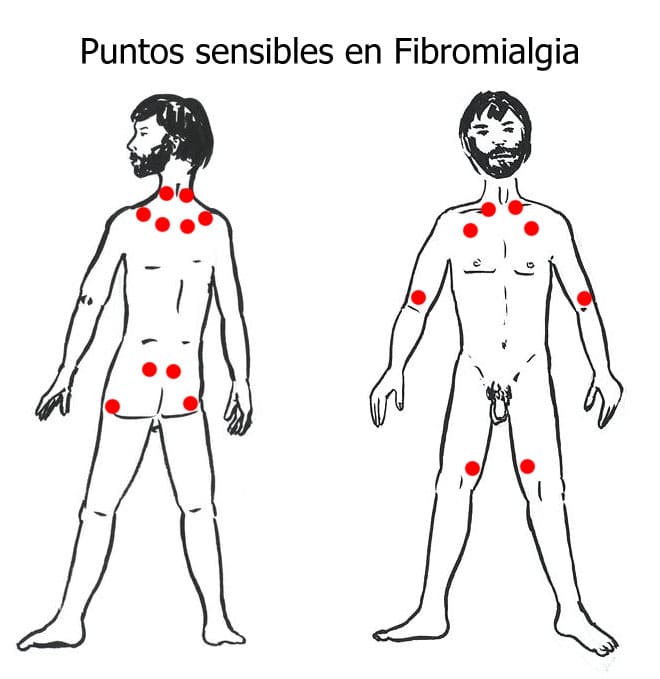 Fibromyalgia