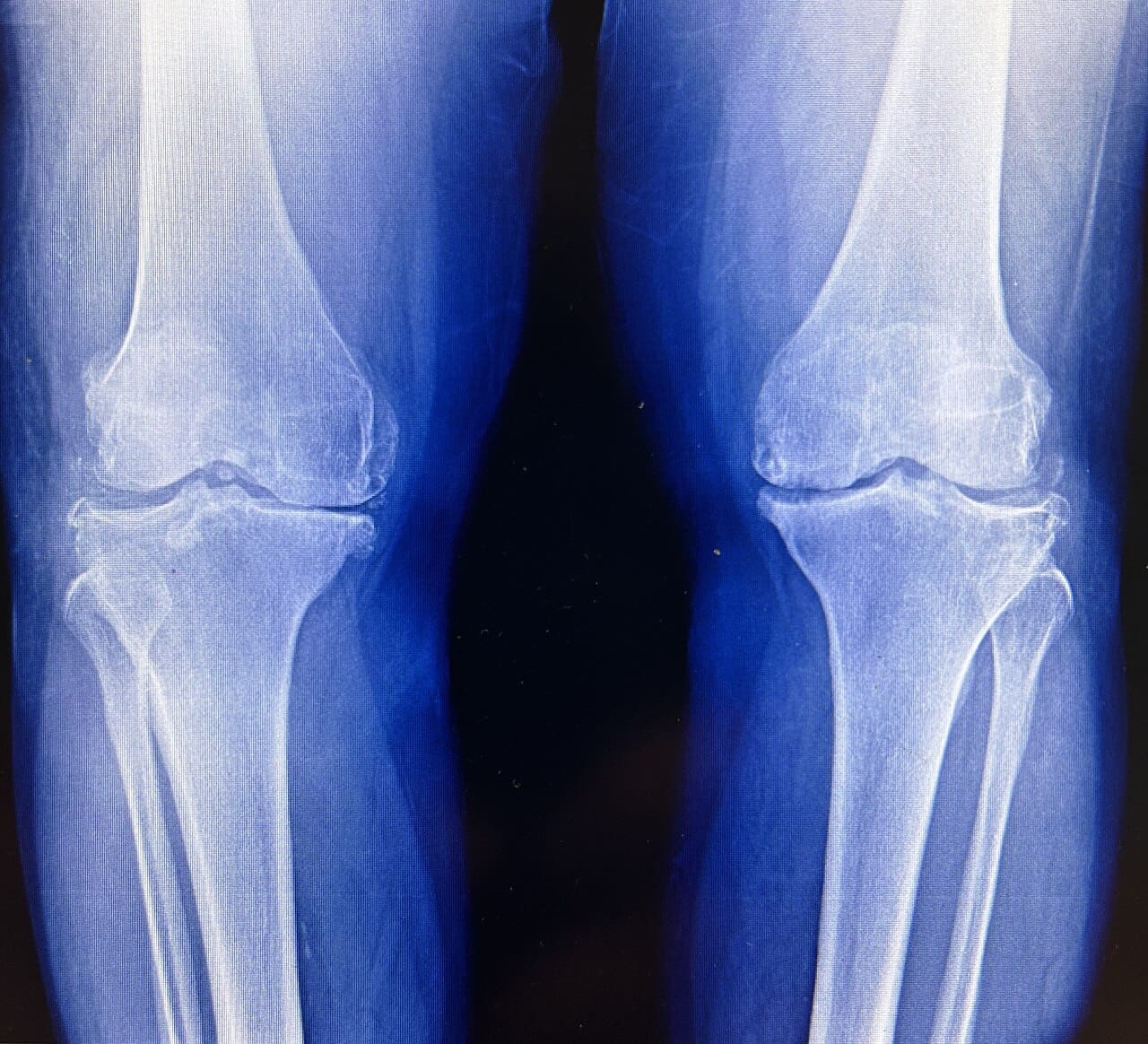 Osteoarthritis (Knee, Hip, Spine)