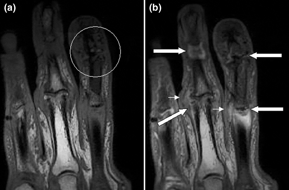 Psoriatic Arthritis