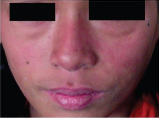 Lupus (SLE) Management