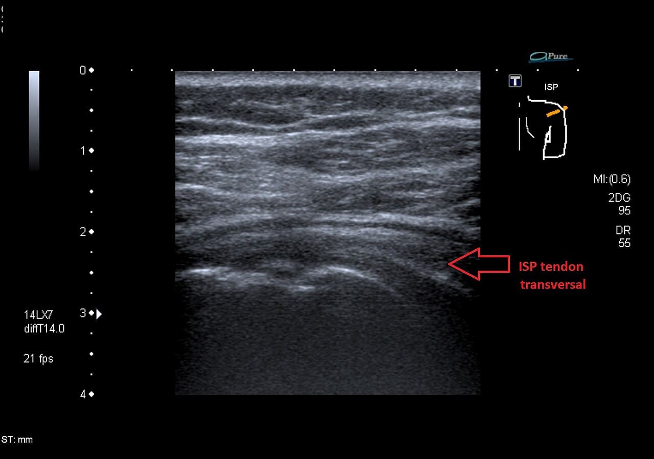 Soft Tissue Rheumatism