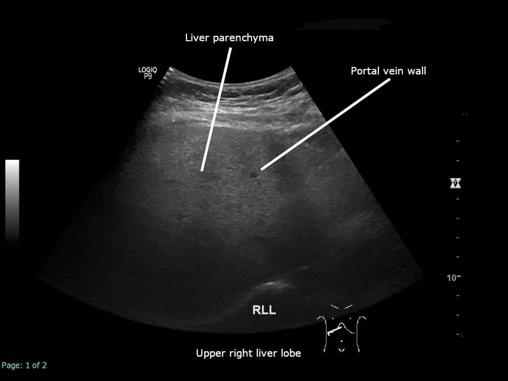 Liver Disorders (Fatty Liver, Hepatitis)