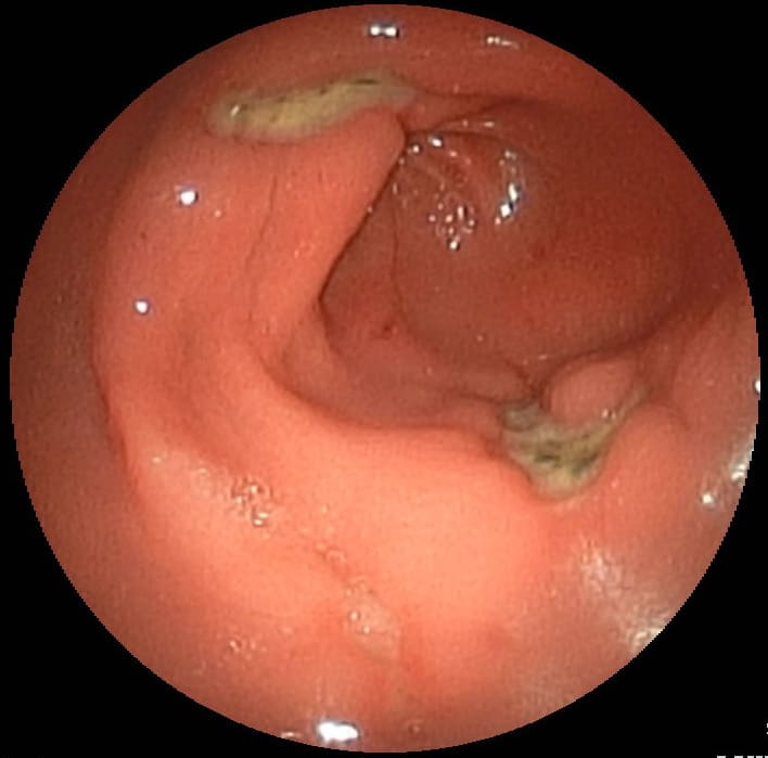 Gastritis & Ulcers