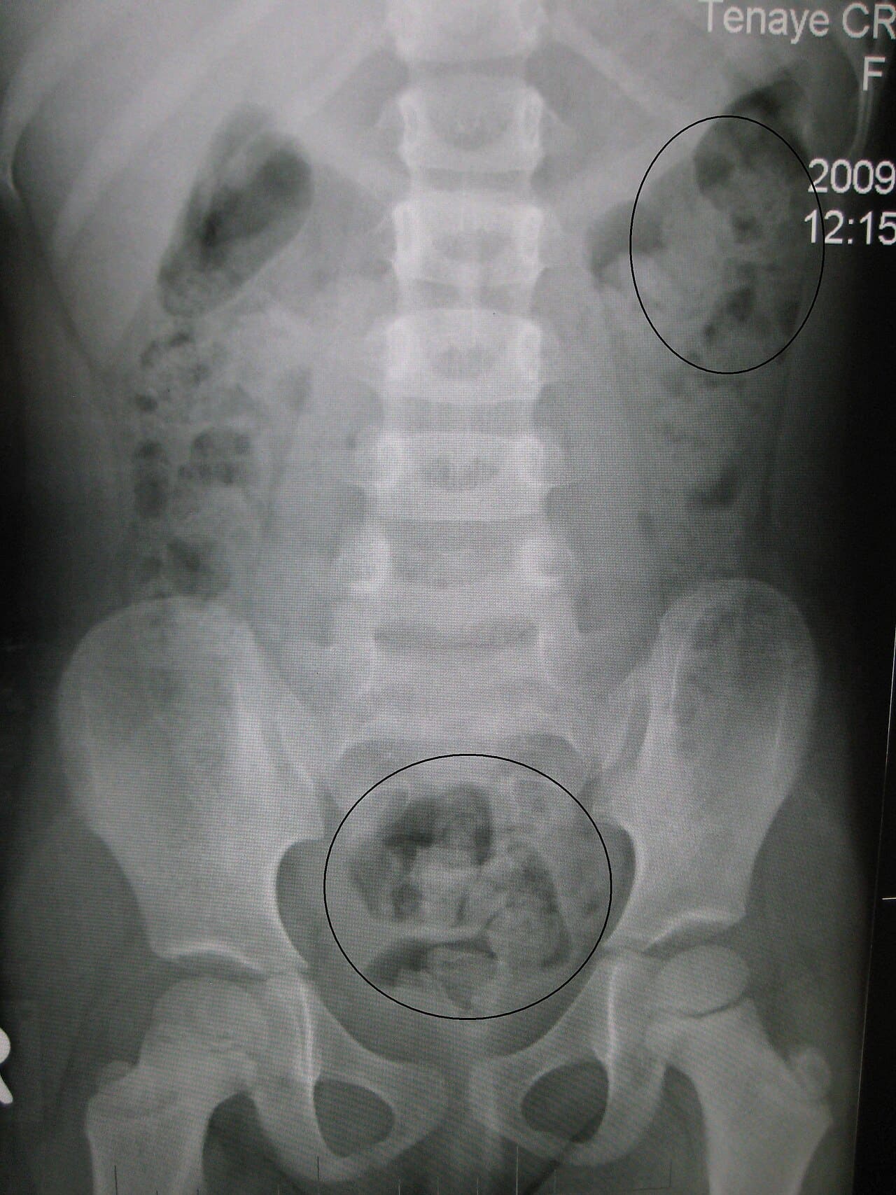 Constipation & Digestive Issues