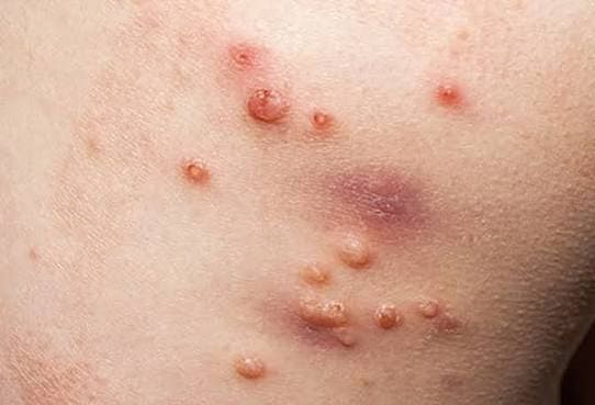 Fever Management (Viral, Bacterial)